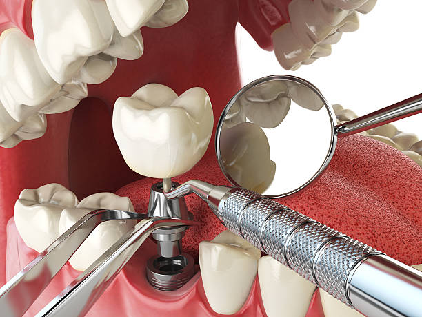 Best Urgent Tooth Repair  in Bonne Terre, MO